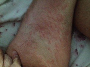 Ant bite welts on my leg; hand in the foreground.