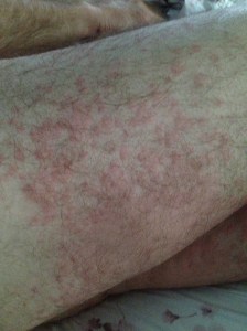 Ant bite welts on my legs. Not a pretty site. But . . . "you should have seen the other guy!" Ha!